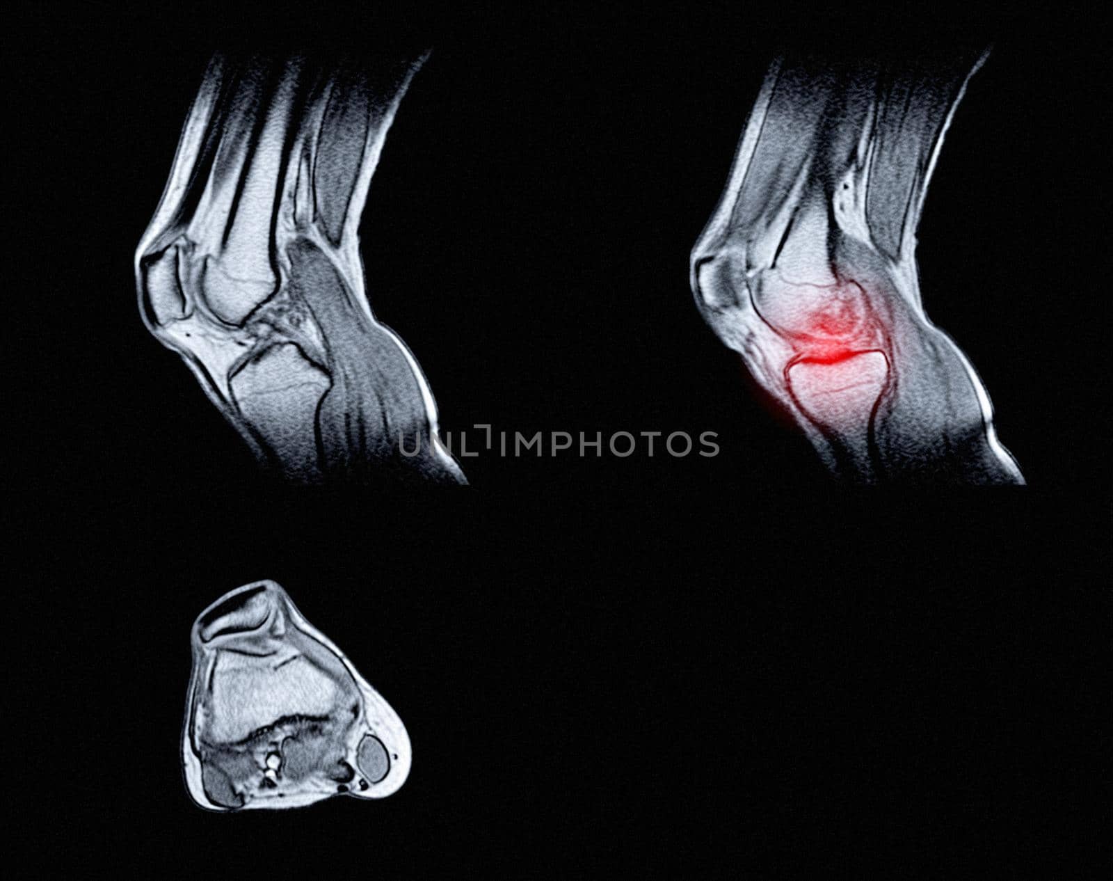 Magnetic resonance imaging (MRI) of right knee. Closed injury of the knee joint, with manifestations of arthrosis. A crunch in the knee joint.