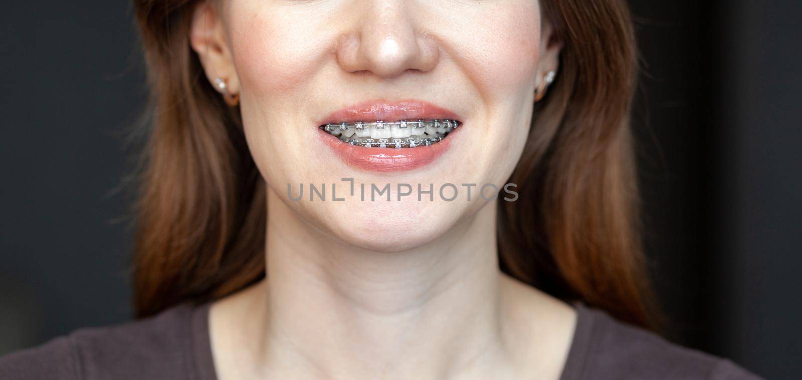 The smile of a young and beautiful girl with braces on her white teeth. Straightening of crooked teeth with the help of a bracket system. Malocclusion. Dental care. Smooth teeth and a beautiful smile