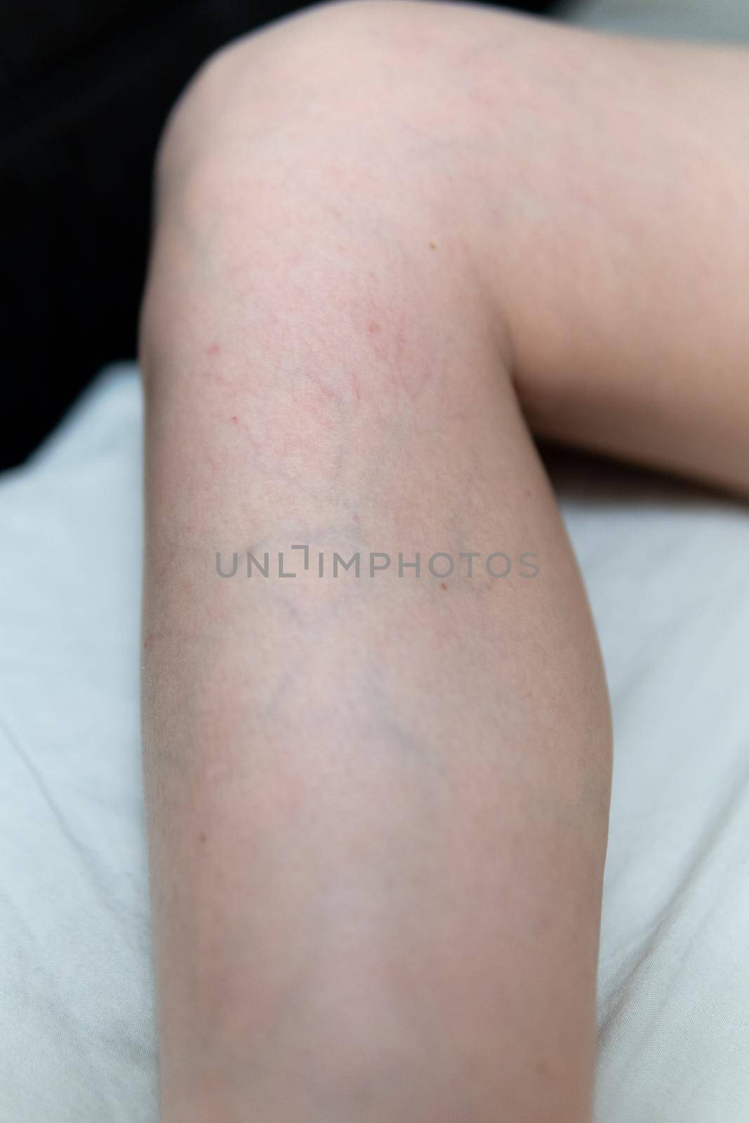 removal of blood vessels by laser vessel body surgery, spider painful cosmetic veins pathology. Help lifestyle twisted, aesthetic telangiectases physical