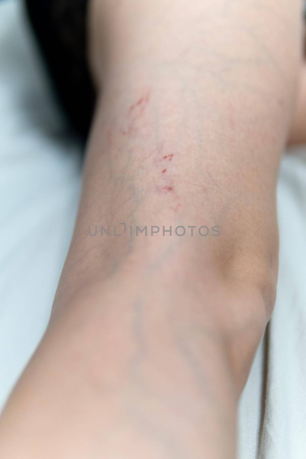 removal of blood vessels by laser vessel blood, varicose treatment care health therapy, veins pathology. Help risk enlarged, tortuous telangiectases physical