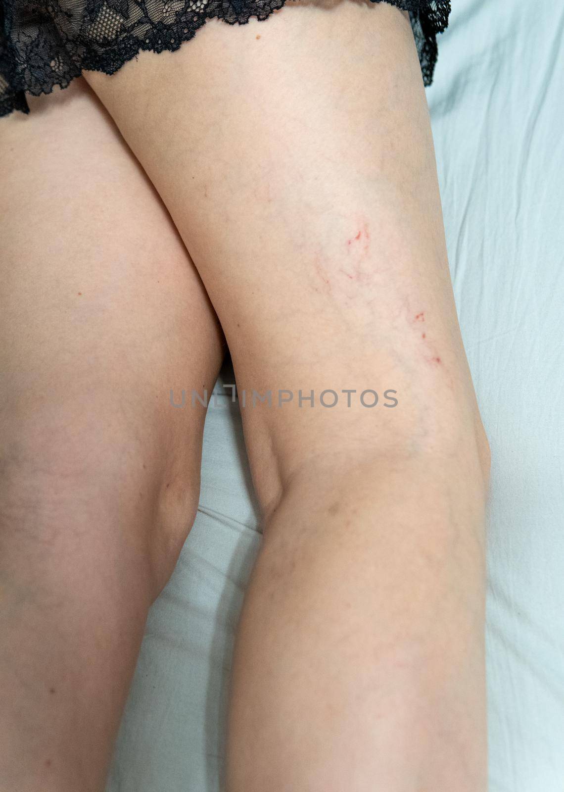 removal of blood vessels by laser thrombosis venous surgery, problem patient close up, veins anatomy. lifestyle enlarged, dermatological telangiectases physical
