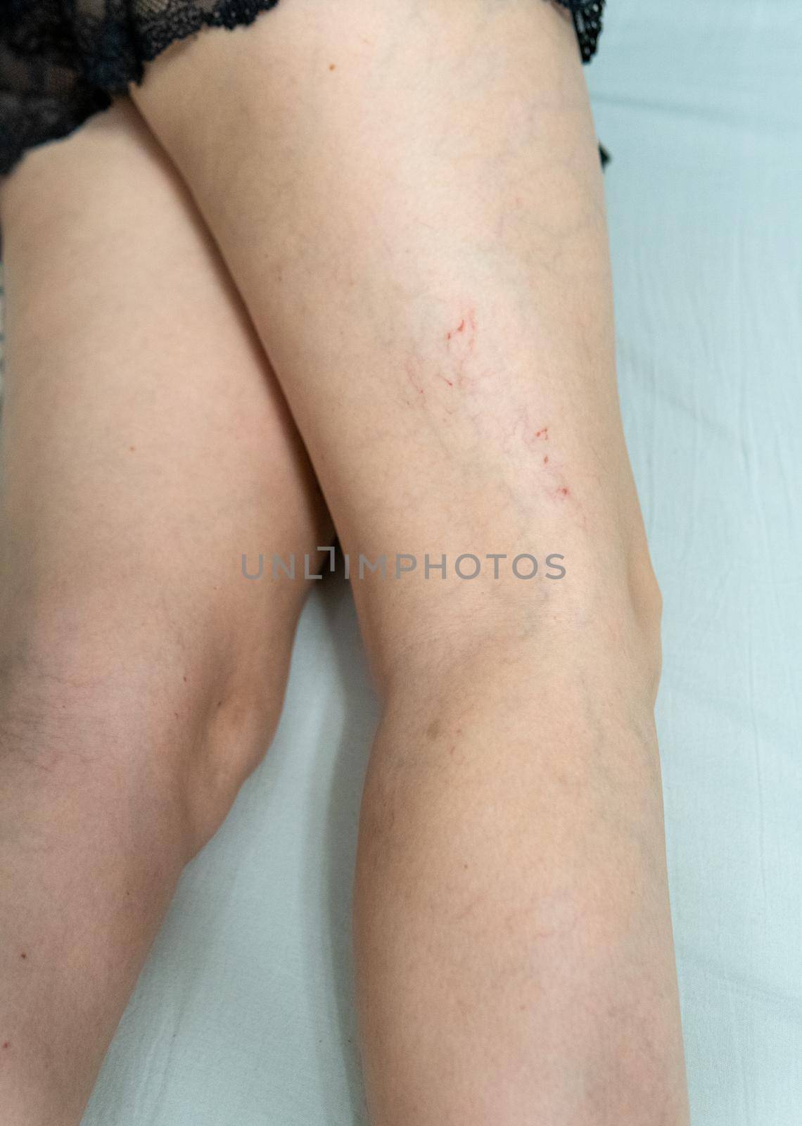 removal of blood vessels by laser vessel dermatology laser skin close up, pain inflammation. Phlebitis risk enlarged, tortuous telangiectases physical