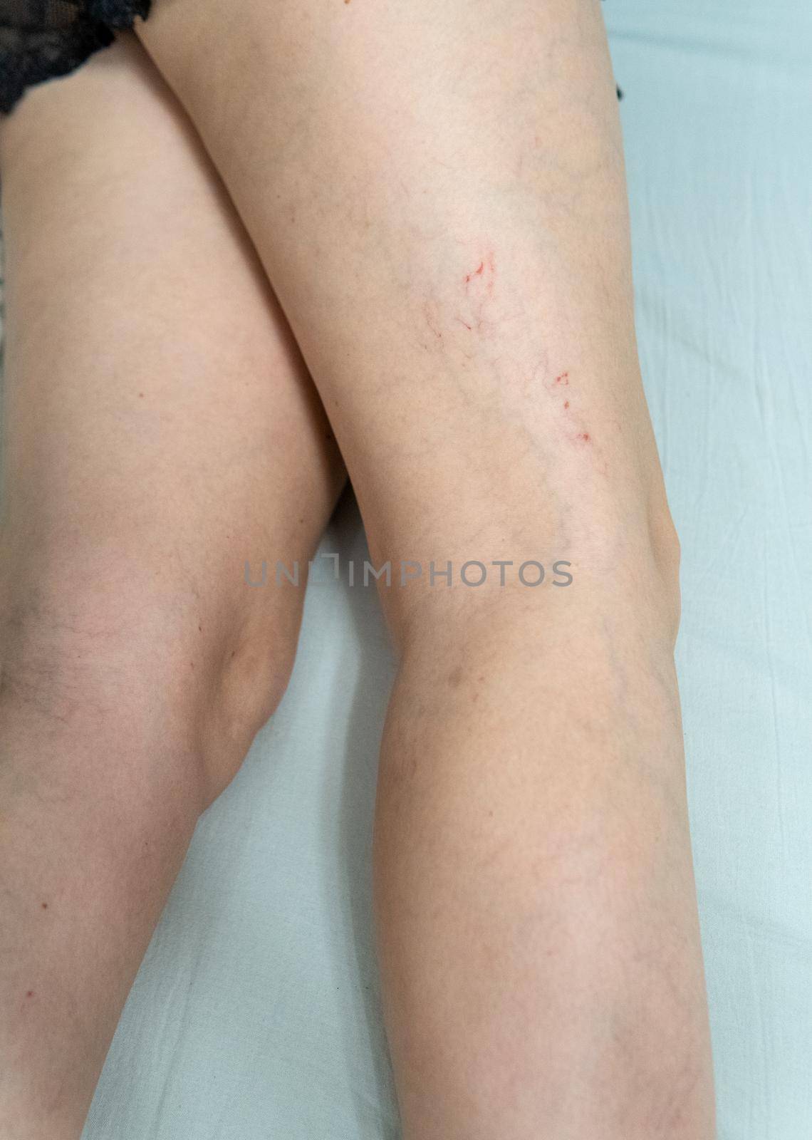 removal of blood vessels by laser surgery, leg treatment beauty, cutout anatomy. Help risk dermis, aesthetic telangiectases physical by 89167702191
