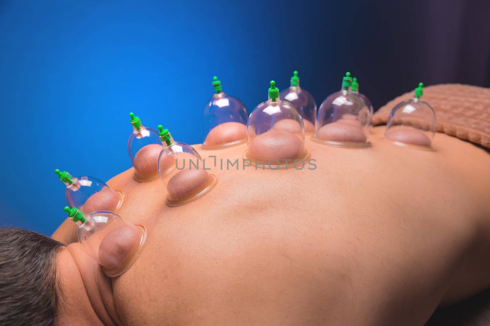 Cup massage in general. Vacuum jars for back massage for a man. Massage with vacuum cups. Cupping treatments for back pain relief. Caucasian man lies face down with mounted vacuum cups on his back by yanik88