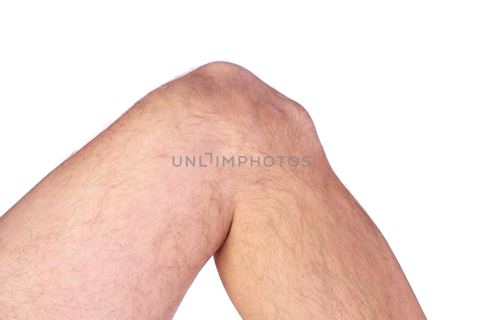 Close up of a Man's Knee with Osgood Schlatter Disease Isolated on a White Background by markvandam