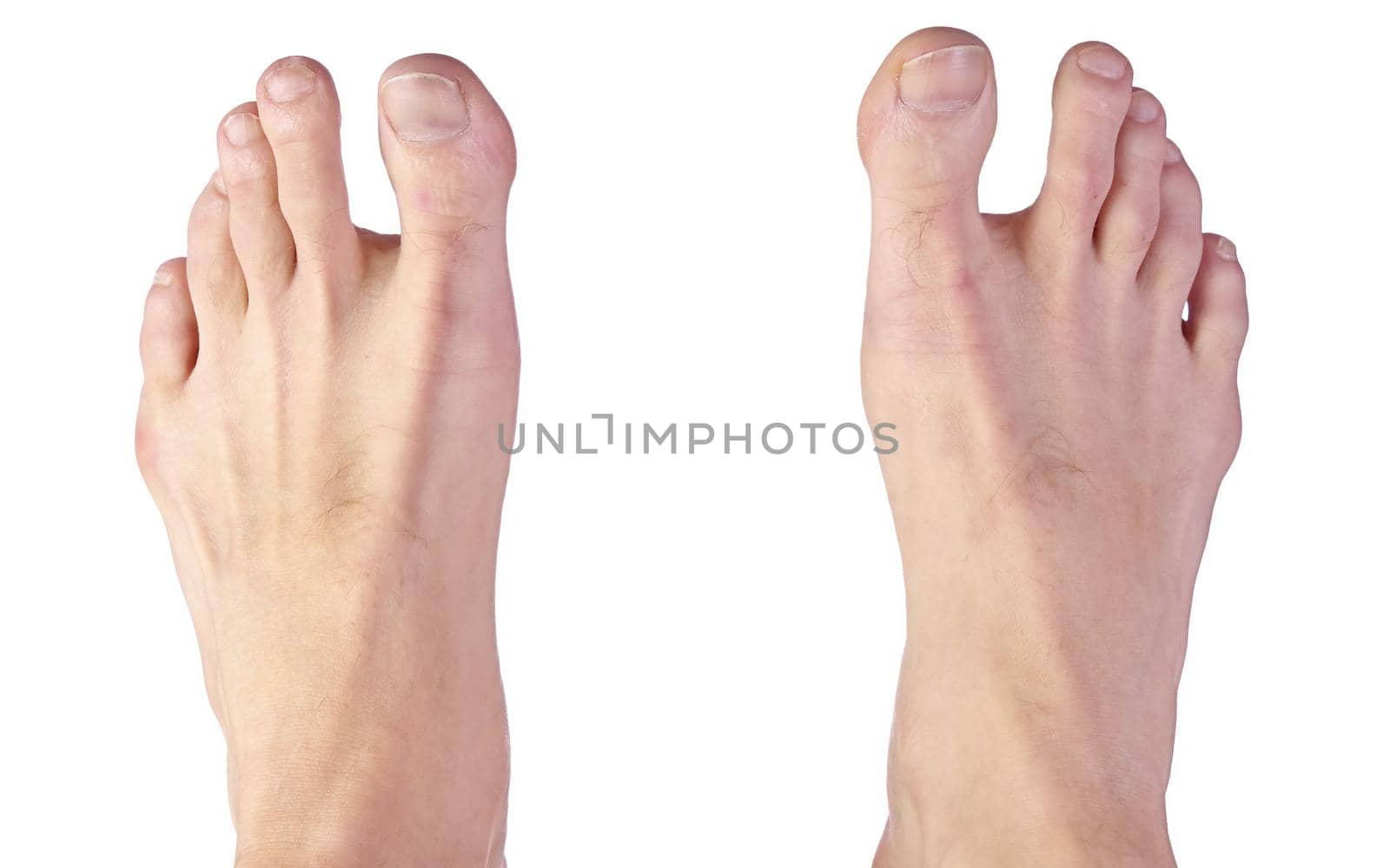 Close up of a Man's Feet Showing Sandal Gap Deformity, also known as Hallux Varus Isolated on a White Background. High quality photo