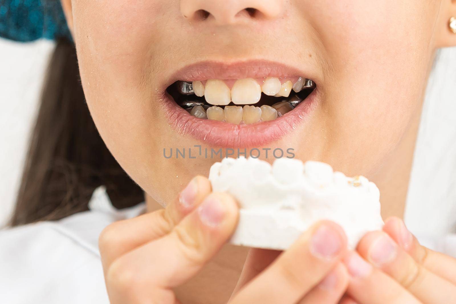 Teenager is holding a dental cast model at the start of orthodontic treatment alongside her teeth after the treatment was completed. by Andelov13
