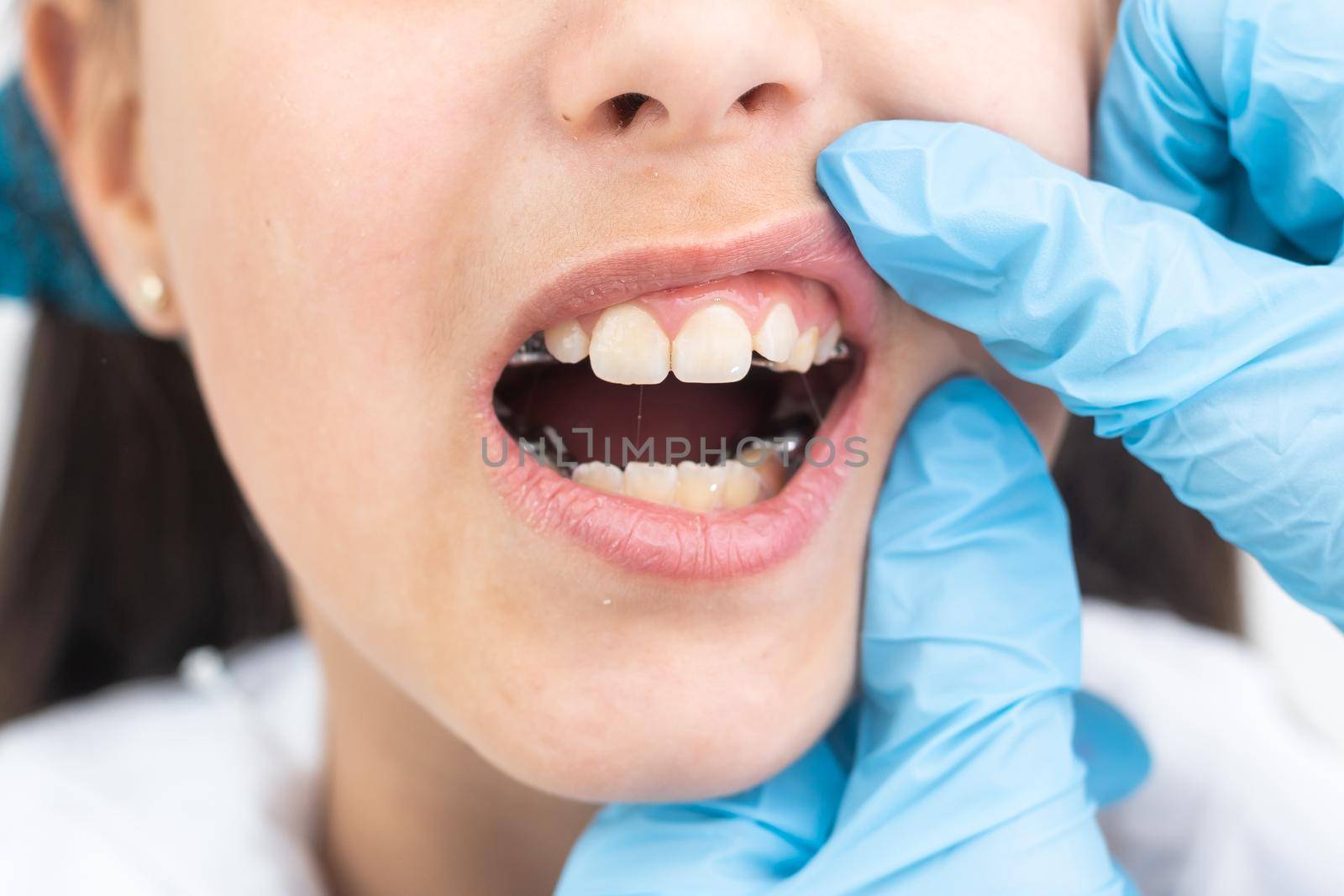 Girl putting on medical braces for orthodontic treatment over white
