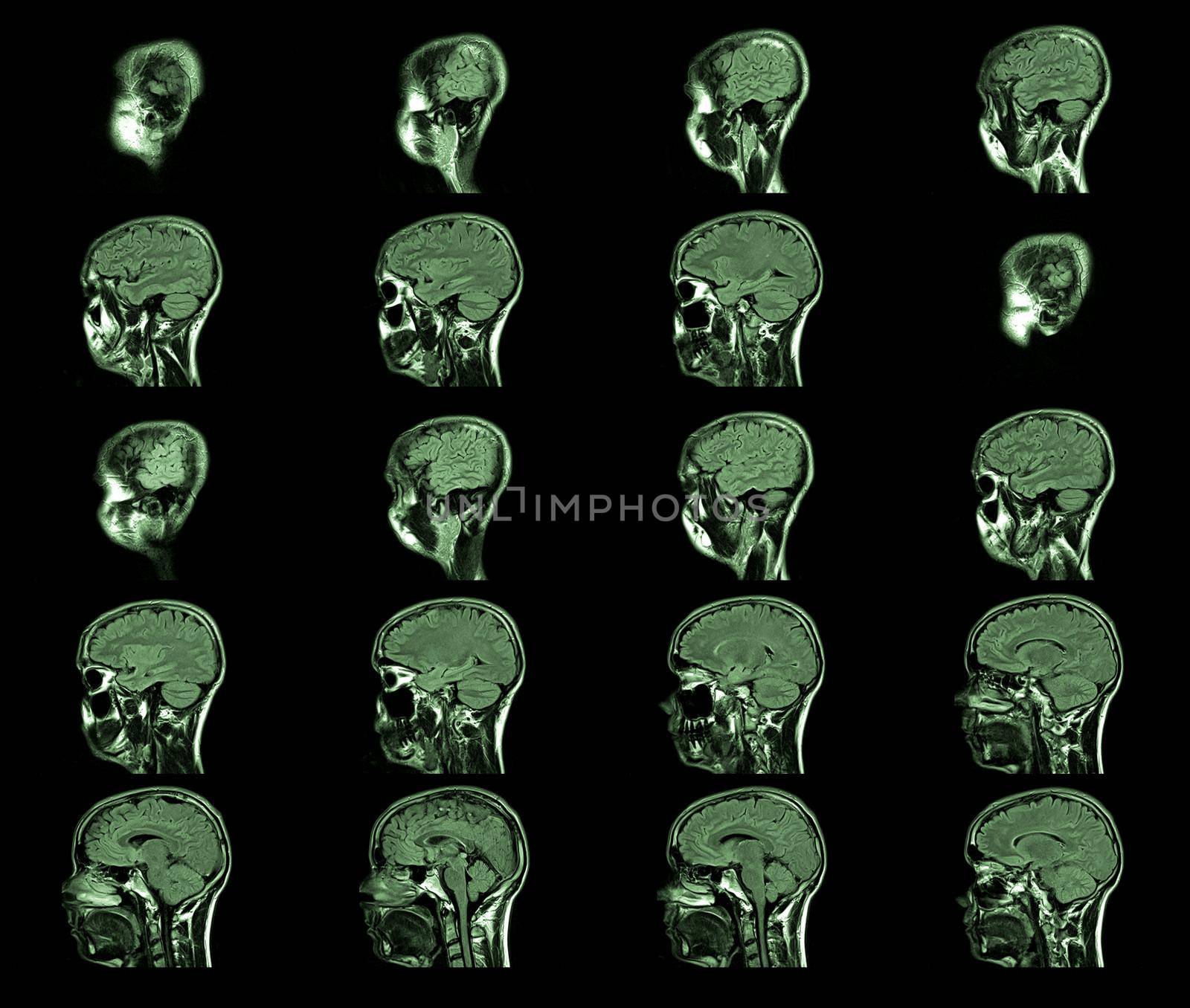 magnetic resonance imaging, MRI MRT head by bildgigant