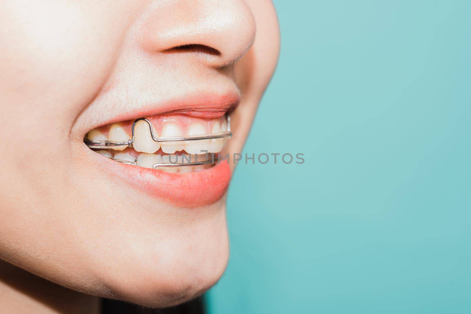 Close up white teeth of young Asian beautiful woman smiling wear silicone orthodontic retainers by Sorapop
