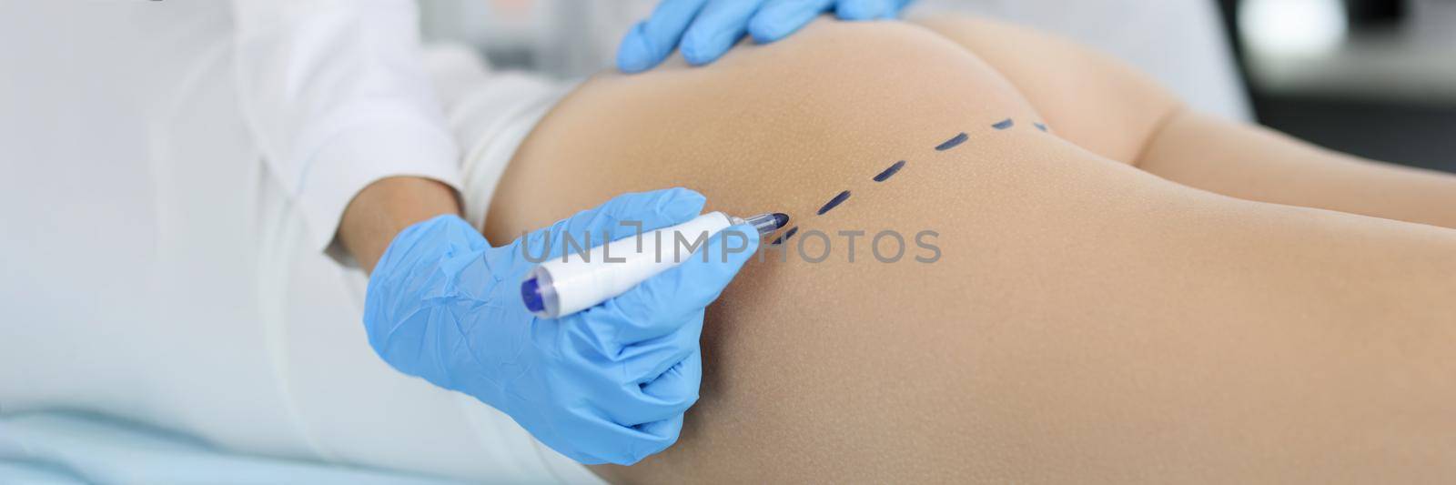 Doctor making preoperative marking on patient buttocks closeup by kuprevich