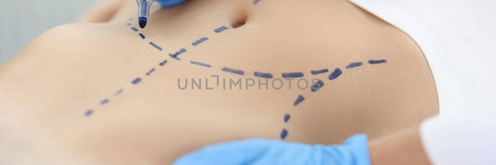 Doctor plastic surgeon drawing preoperative markings on skin of patient abdomen closeup by kuprevich
