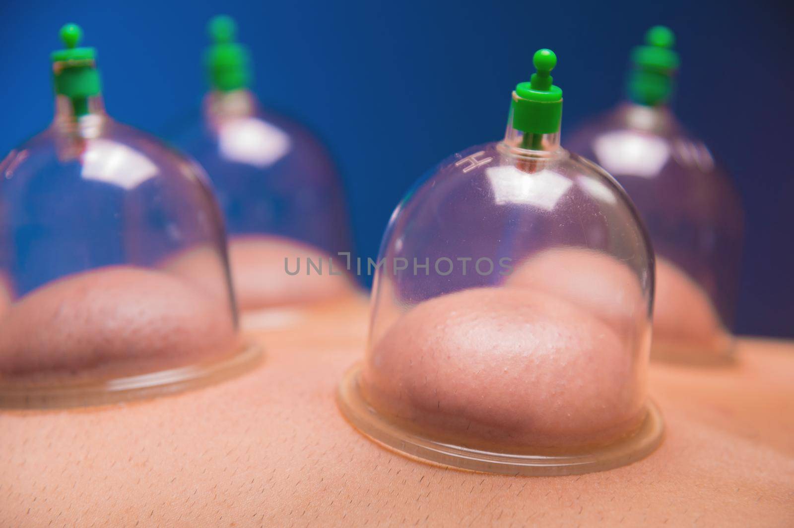 Close-up Cup massage in general. Vacuum jars for back massage for a man. Massage with vacuum cups. Cupping treatments for back pain relief. Caucasian man lies face down with mounted vacuum cups by yanik88