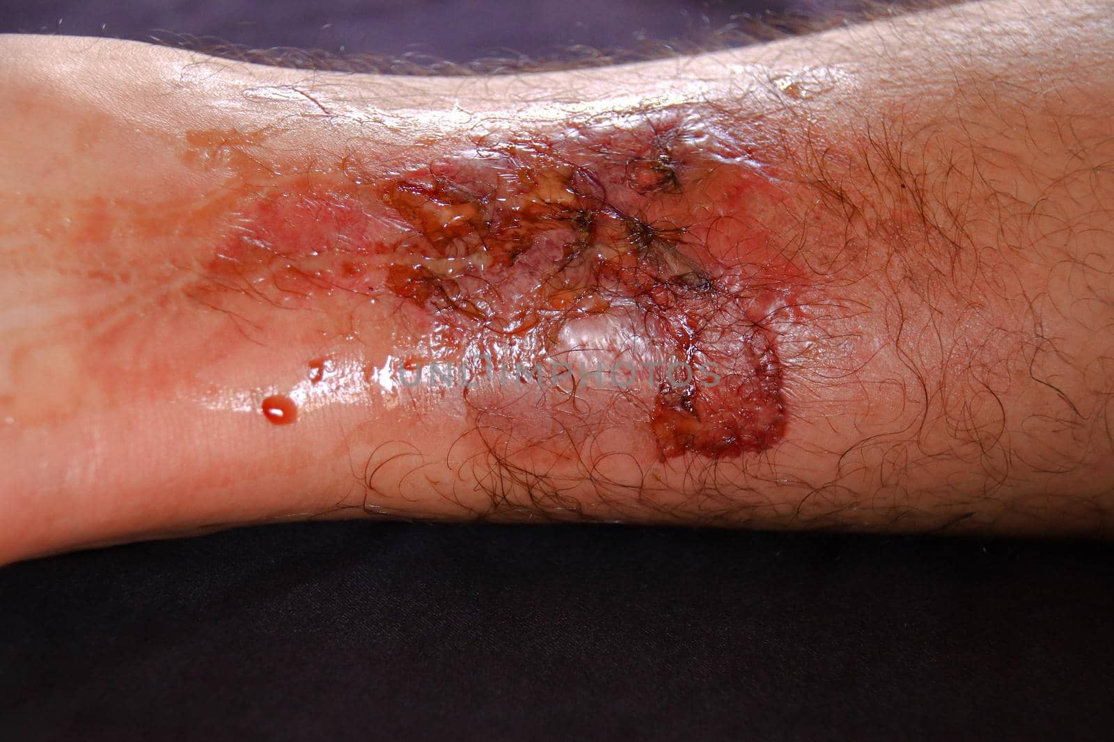 A third-degree burn on the leg by Sonnet15