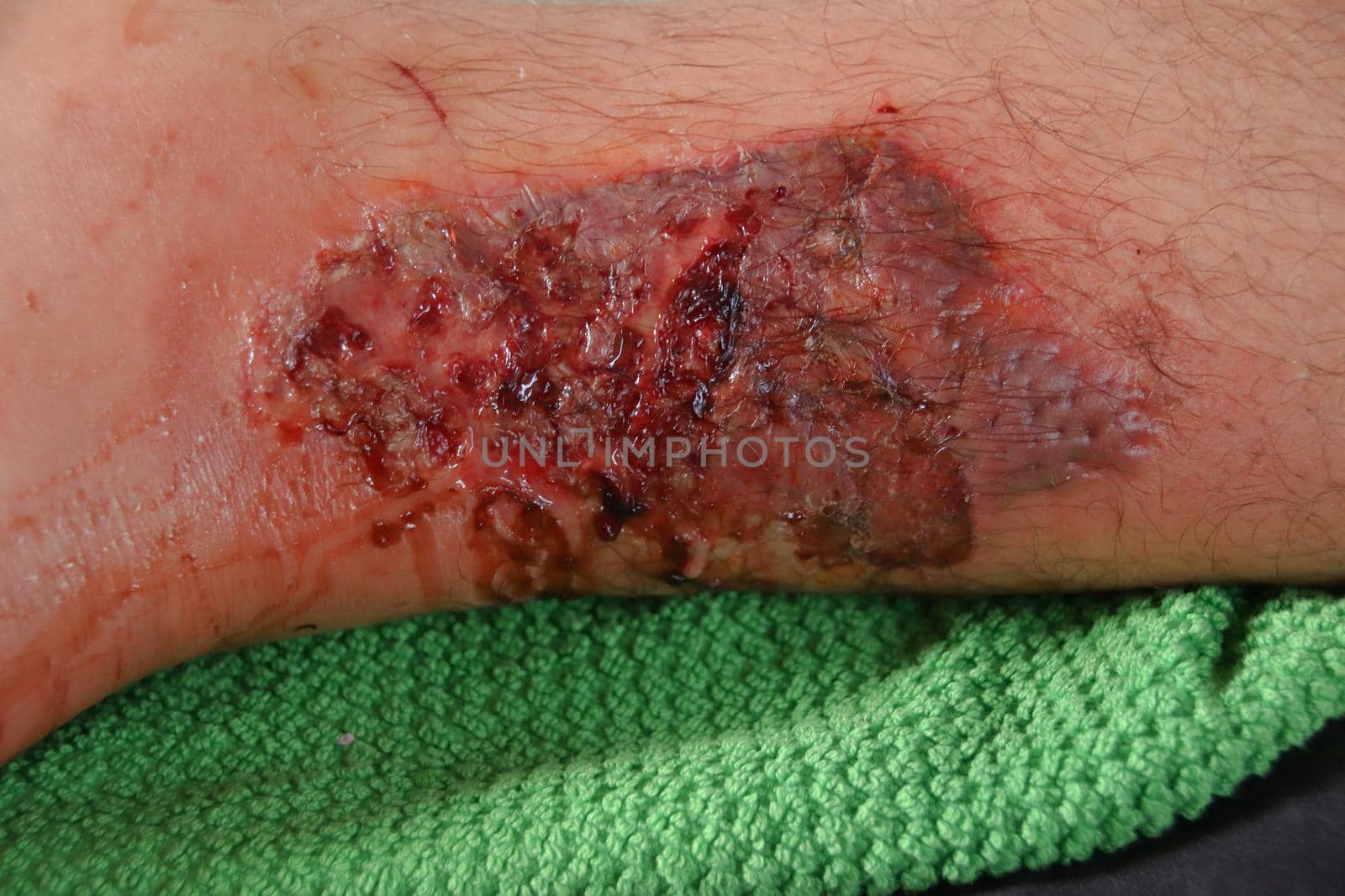 A third-degree burn on the leg of a Caucasian male against black background