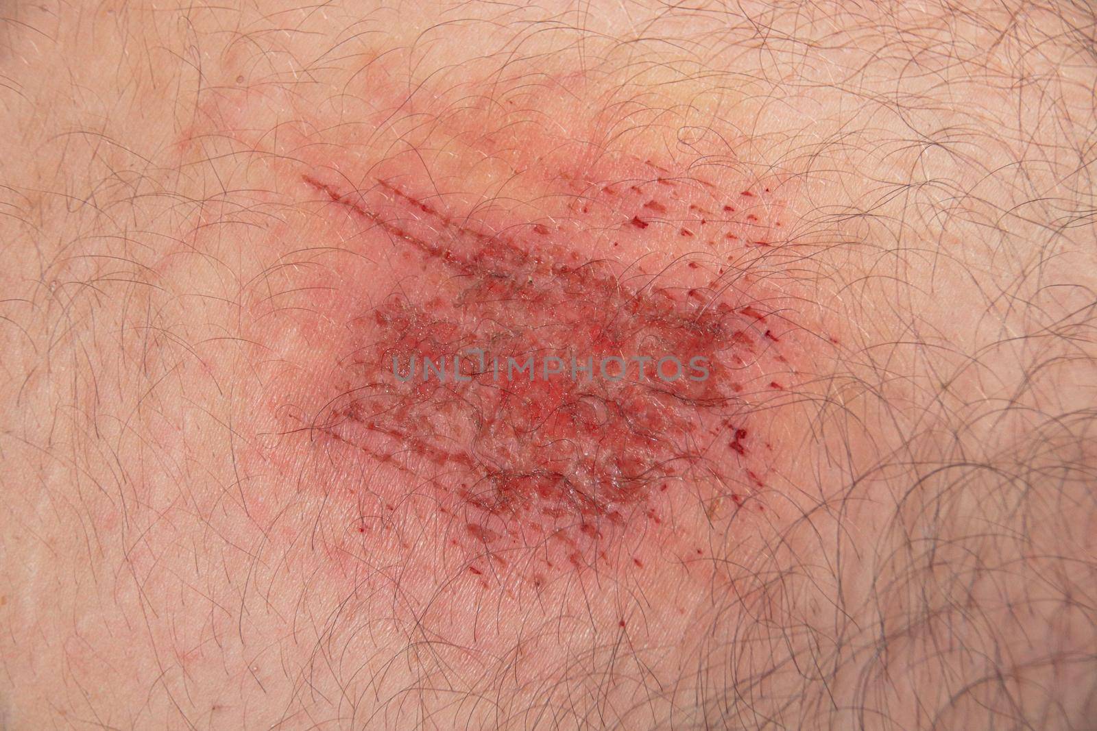 Close up of an abrasion wound in Caucasian skin