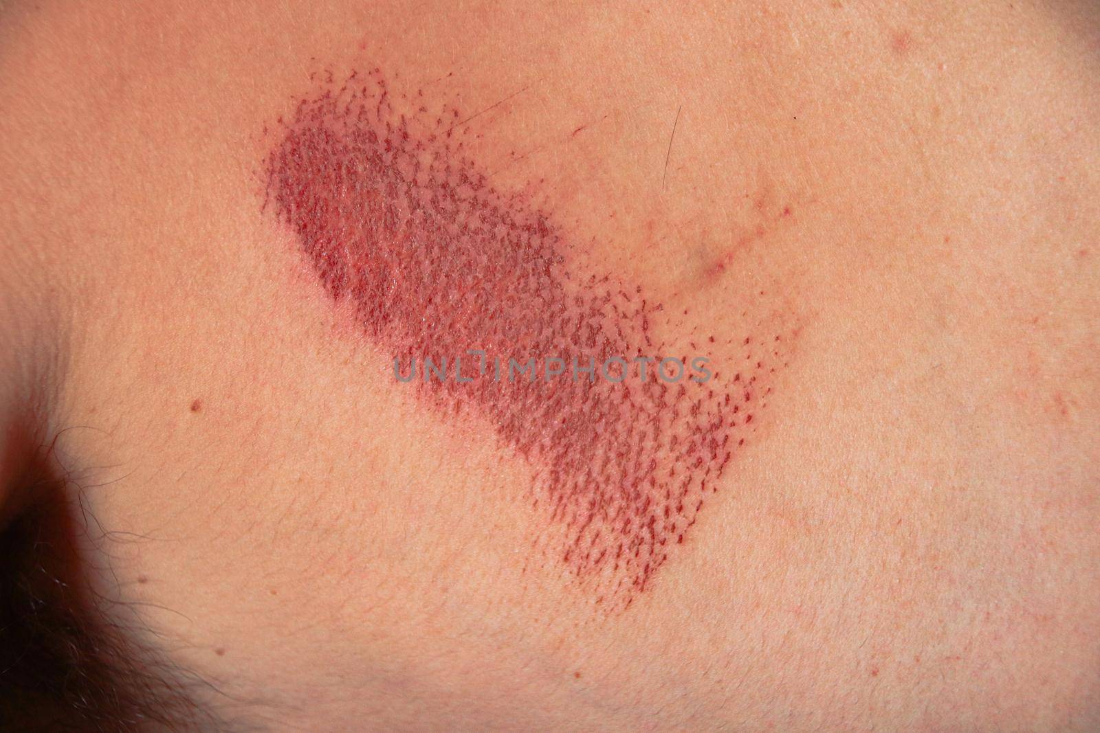 Close up of an abrasion wound in Caucasian skin