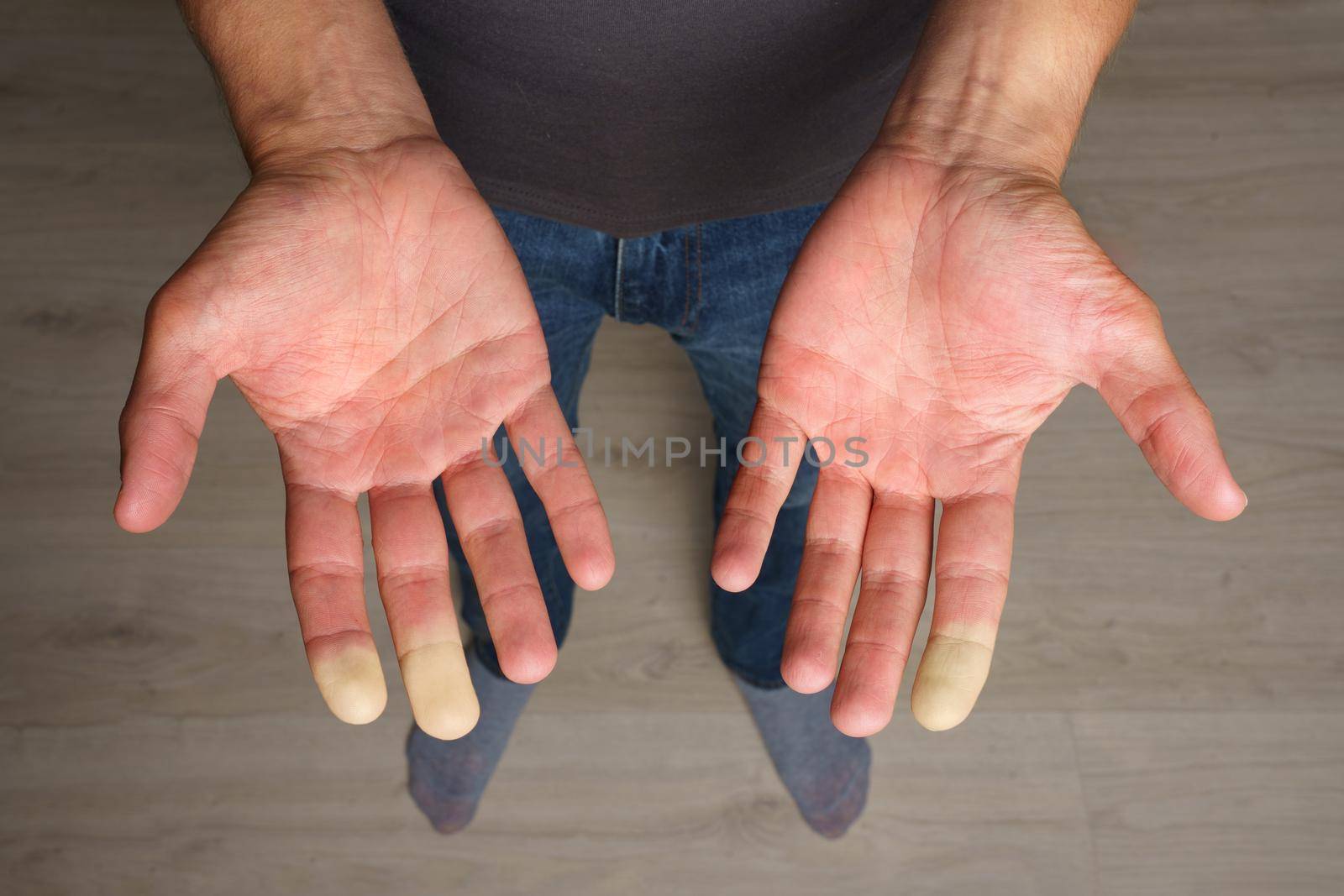 Man showing hands with Raynaud syndrome, Raynaud's phenomenon or Raynaud's disease. High quality photo