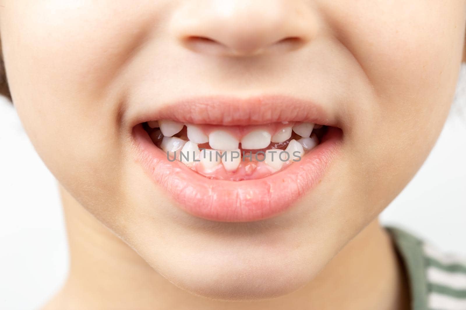 Close up of the child mouth without one bottom front tooth. Dental health concept