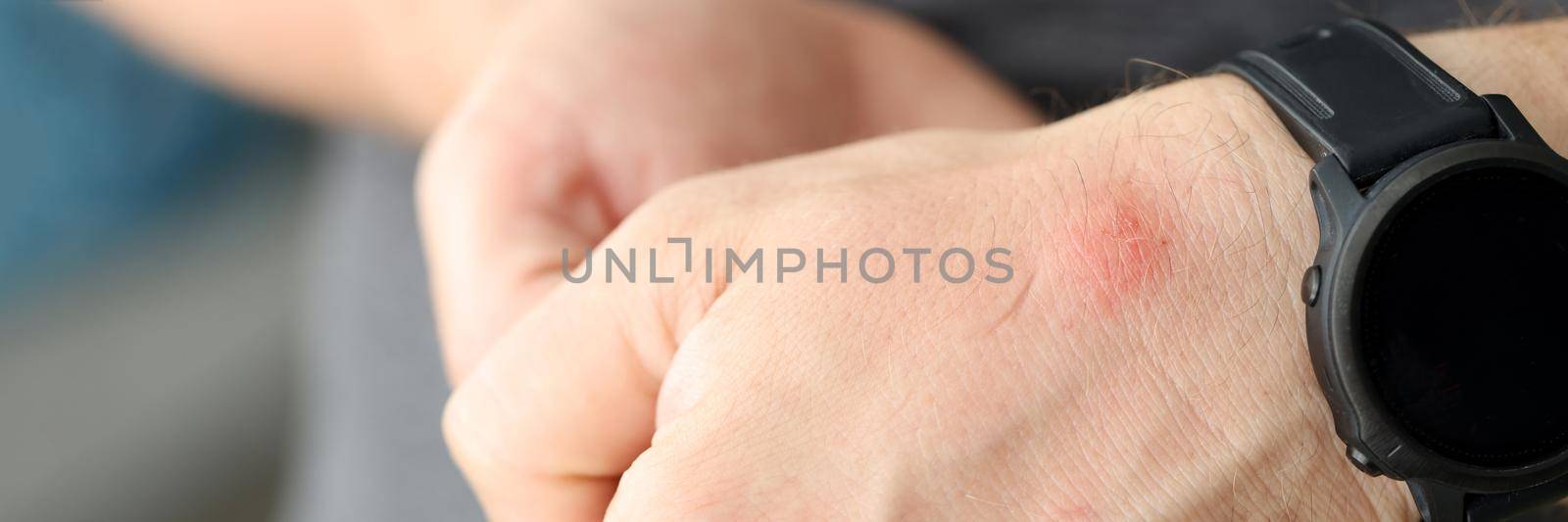 Closeup of red spot on skin of man hand. Insect bite treatment concept