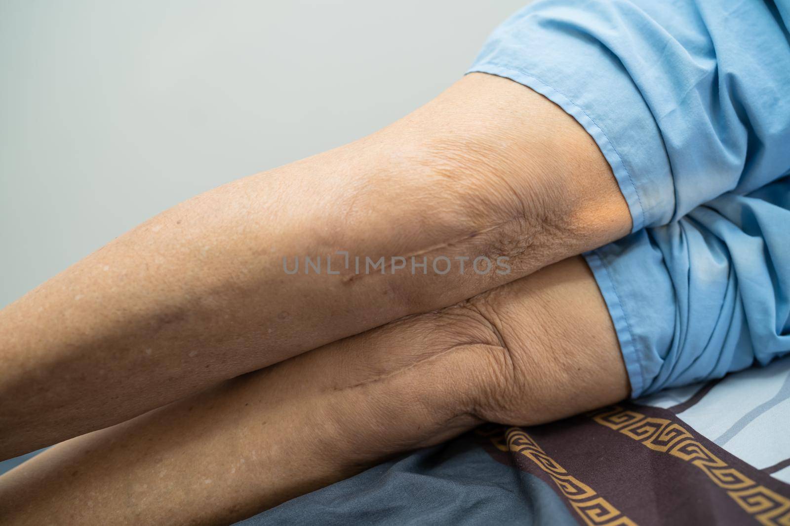 Asian senior or elderly old lady woman patient show her scars surgical total knee joint replacement Suture wound surgery arthroplasty on bed in nursing hospital ward, healthy strong medical concept.