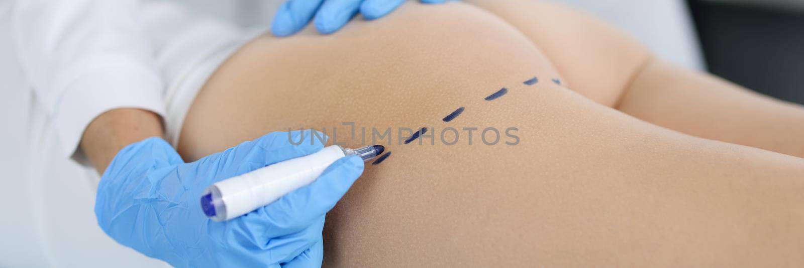 Doctor draws marks on the patient's buttocks with marker for body shaping. Buttocks plastic concept