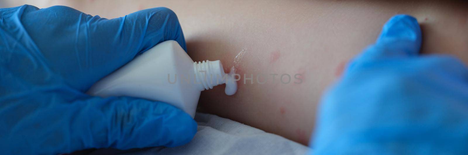 Gloved doctor applies cream to the skin of patient with red itchy inflammations. Insect bites and child skin allergies concept