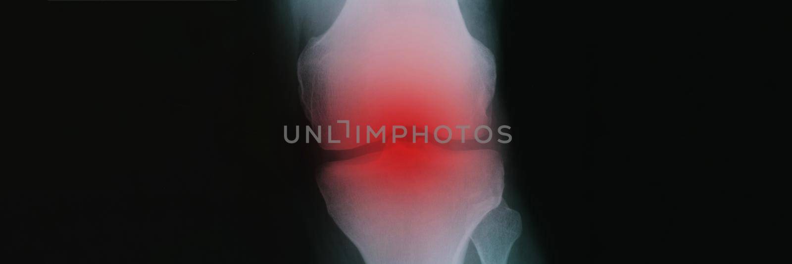 X ray with red inflammation of knee joint closeup. Diagnosis and treatment of arthritis concept