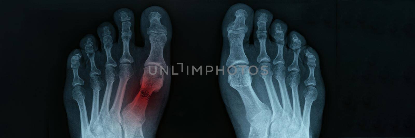 X ray of feet with tarsal fracture closeup. Diagnosis and treatment of lower limb injuries concept