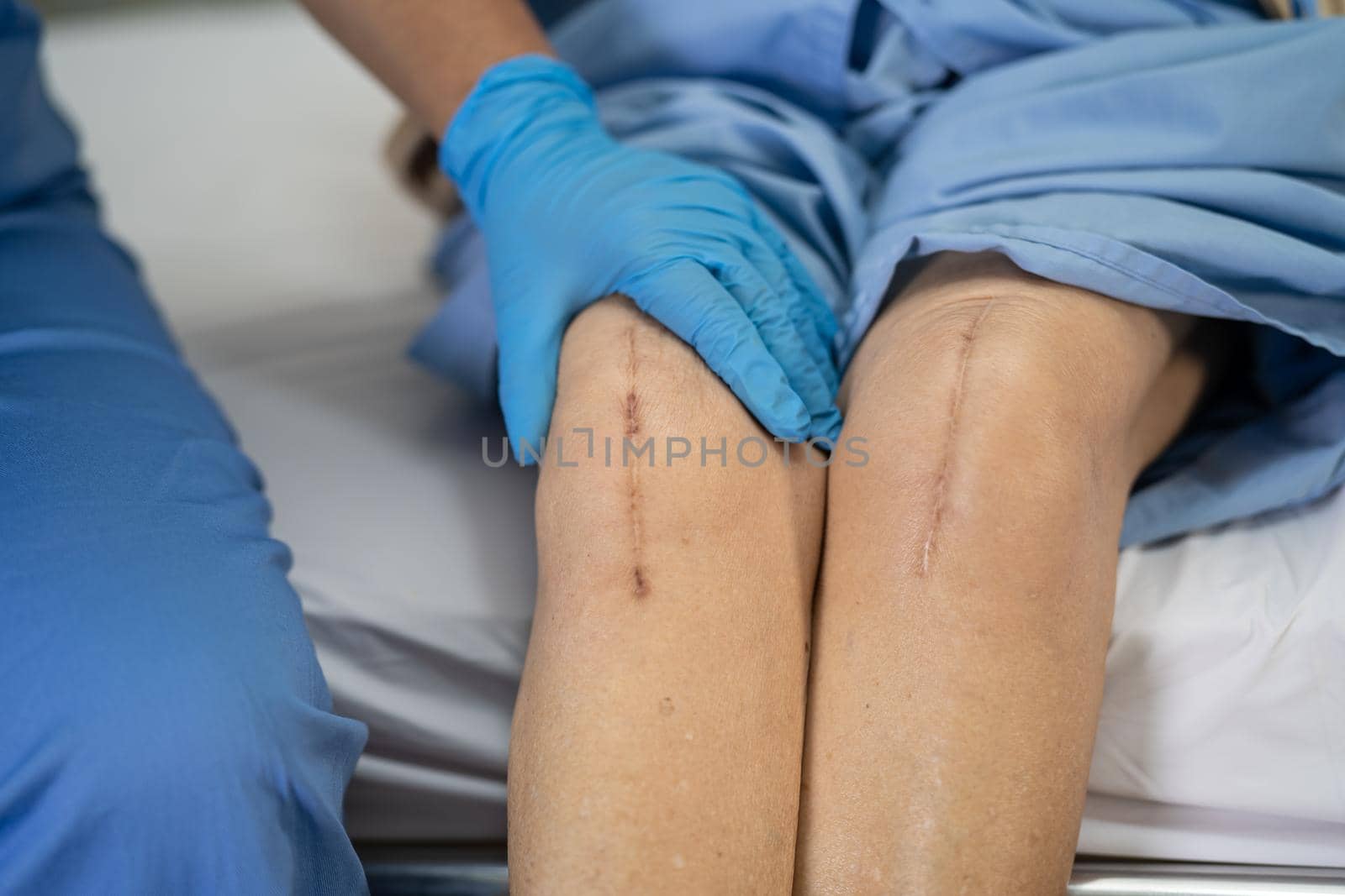 Asian senior or elderly old lady woman patient show her scars surgical total knee joint replacement Suture wound surgery arthroplasty on bed in nursing hospital ward, healthy strong medical concept.