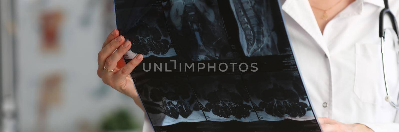 Young woman doctor is holding x-ray of person spine. Lumbar vertebrae displacement concept