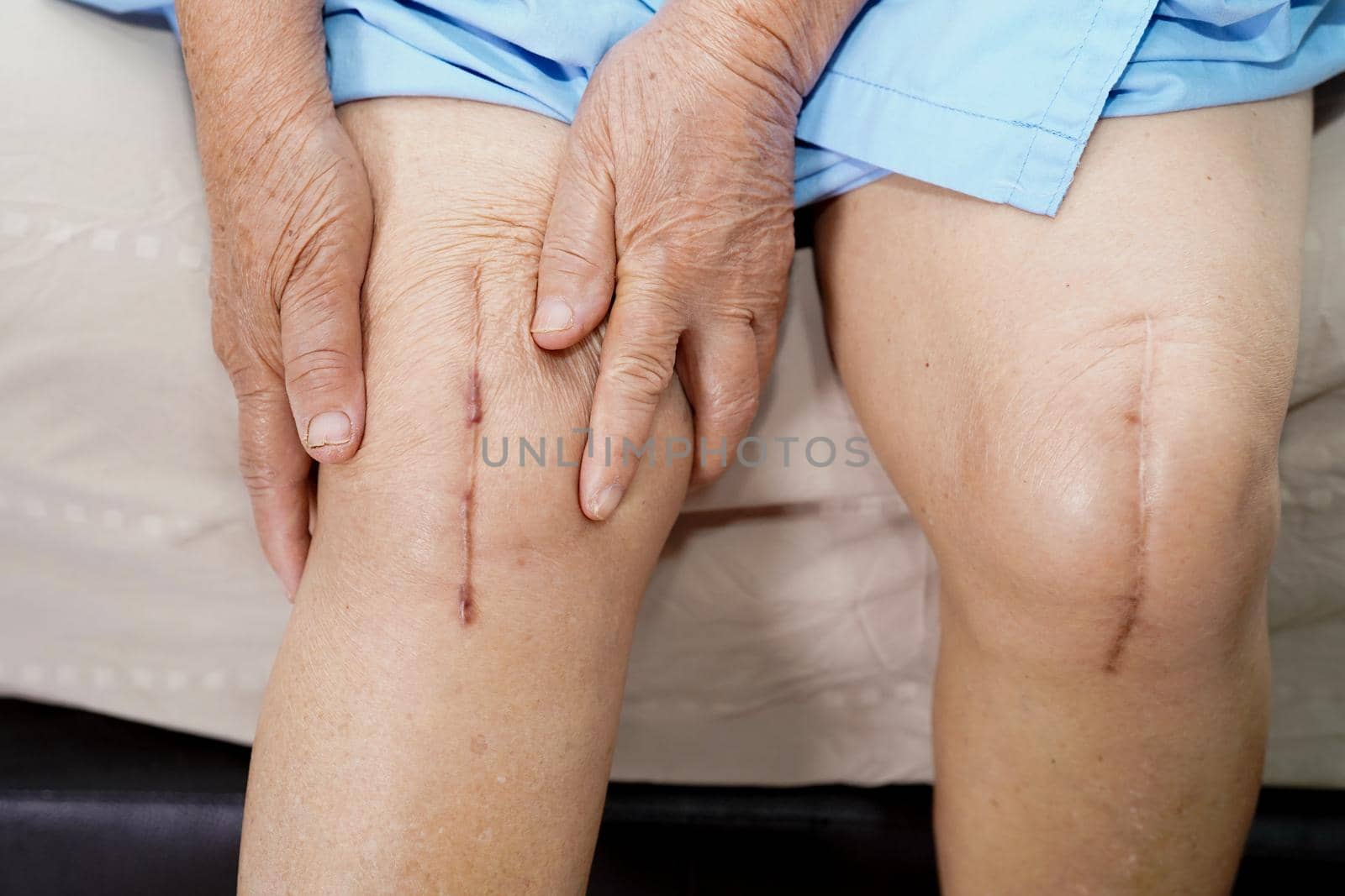 Asian senior or elderly old lady woman patient show her scars surgical total knee joint replacement Suture wound surgery arthroplasty on bed in nursing hospital ward : healthy strong medical concept.