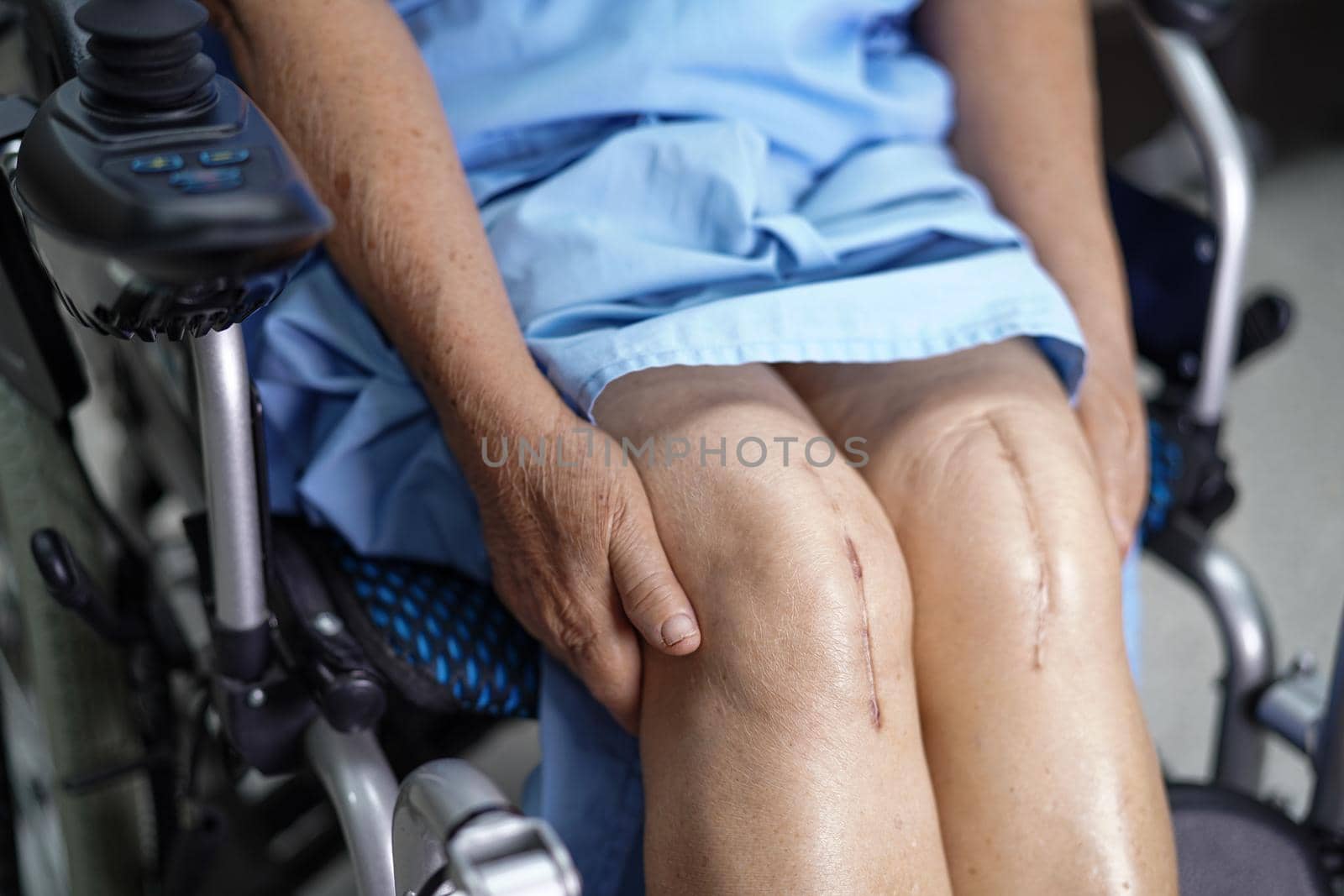 Asian senior or elderly old lady woman patient show her scars surgical total knee joint replacement Suture wound surgery arthroplasty on wheelchair in nursing hospital ward : healthy strong medical concept.