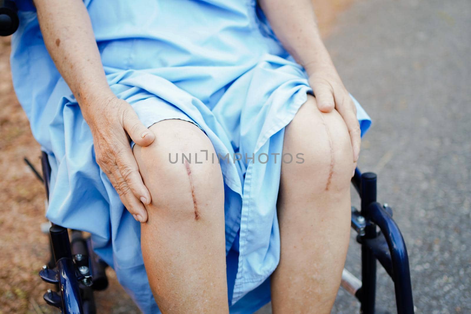 Asian senior or elderly old lady woman patient show her scars surgical total knee joint replacement Suture wound surgery arthroplasty on bed in nursing hospital ward : healthy strong medical concept. by pamai