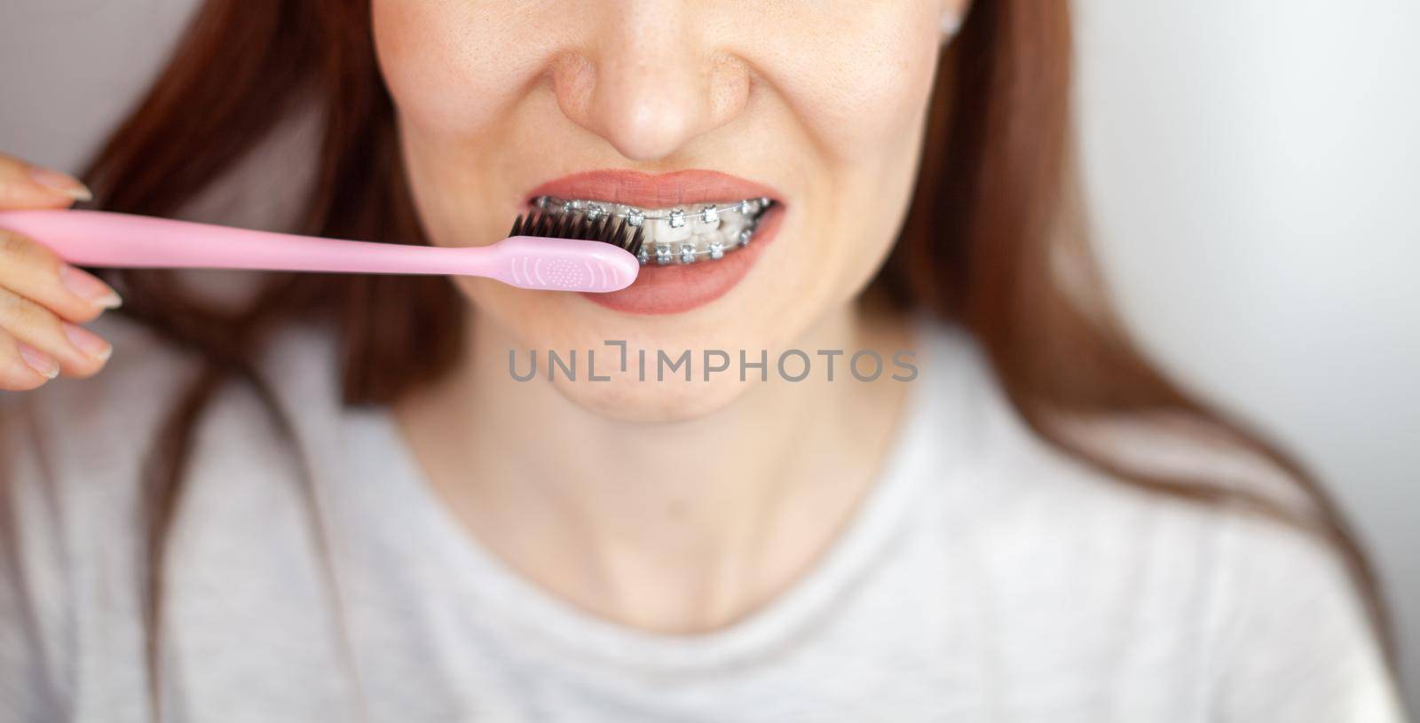 A girl with braces on her white teeth and a toothbrush by AnatoliiFoto