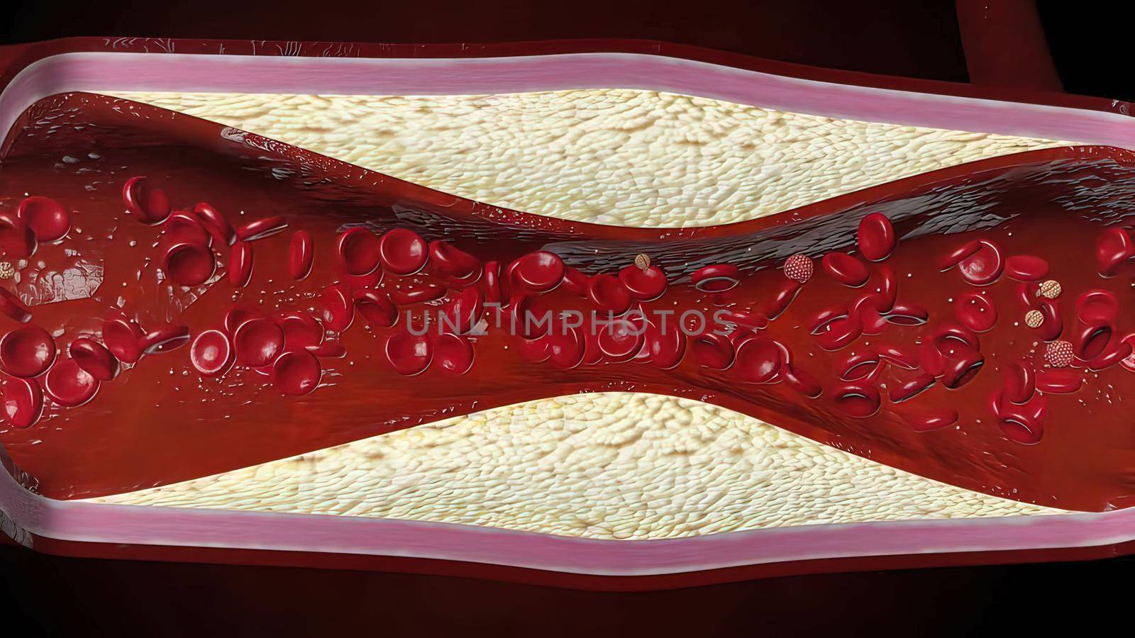 Atherosclerosis with cholesterol blood or plaque in vessel cause of coronary artery disease by creativepic