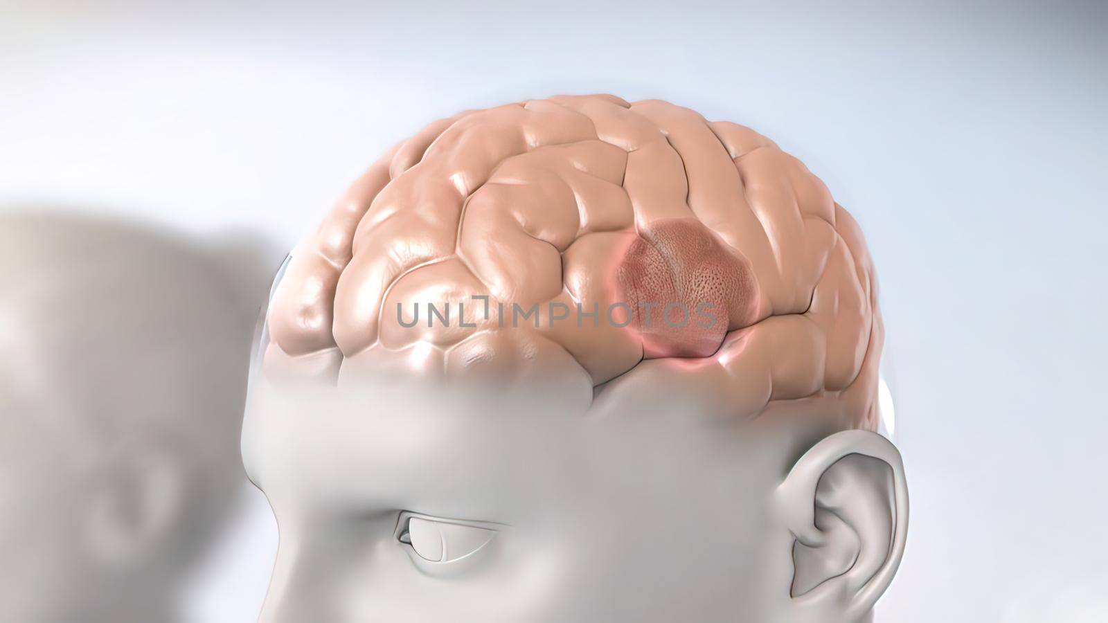 A brain tumor is a collection or mass of abnormal cells in your brain. 3D illustration