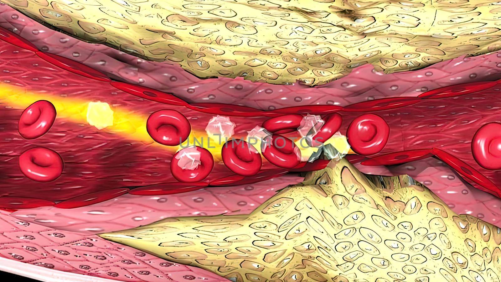Coronary atherosclerosis, light micrograph showing cholesterol-containing plaque in heart coronary artery, photo under microscope 3D Illustration
