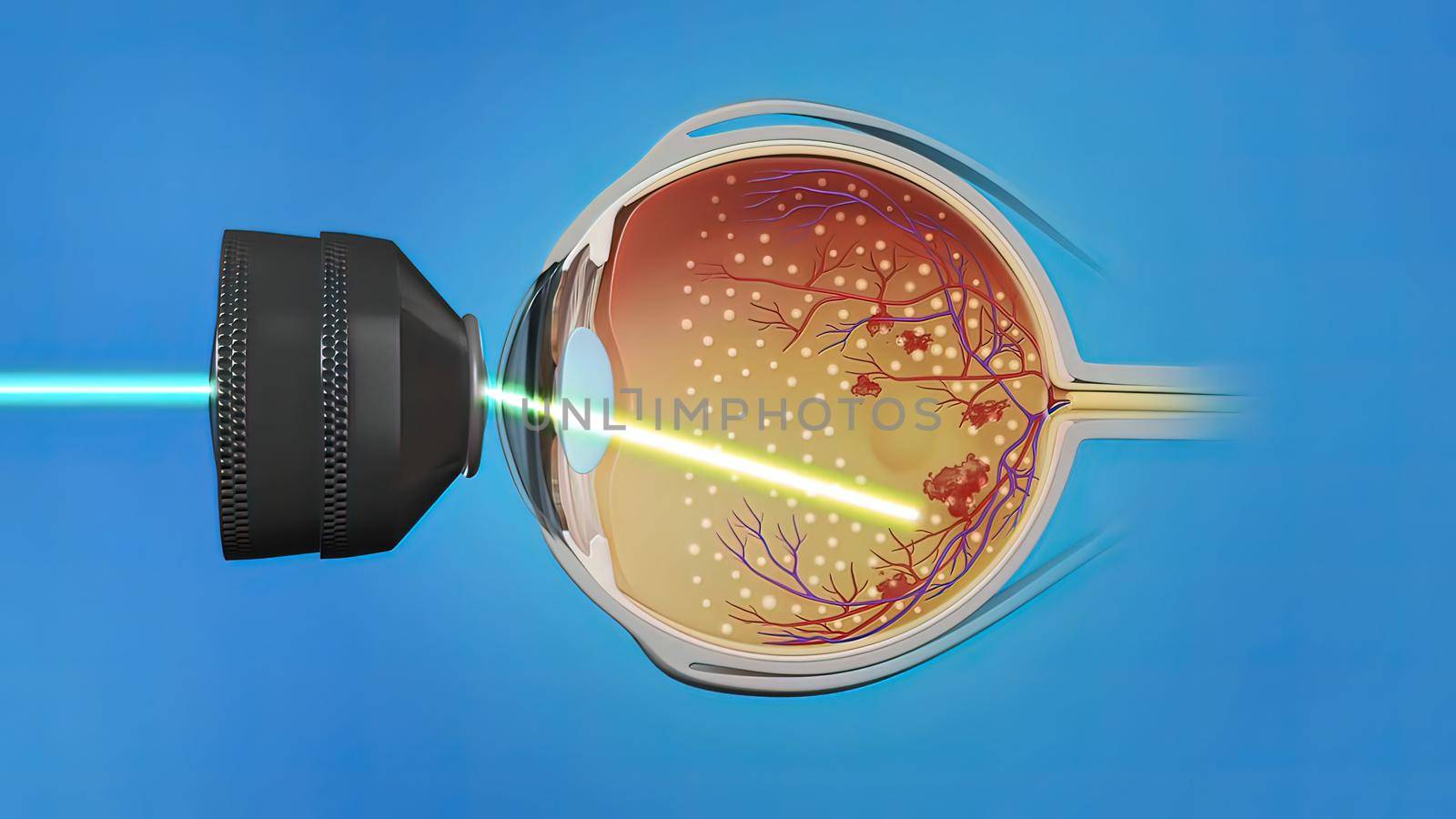 Laser surgery , eye laser treatment 3D illustration