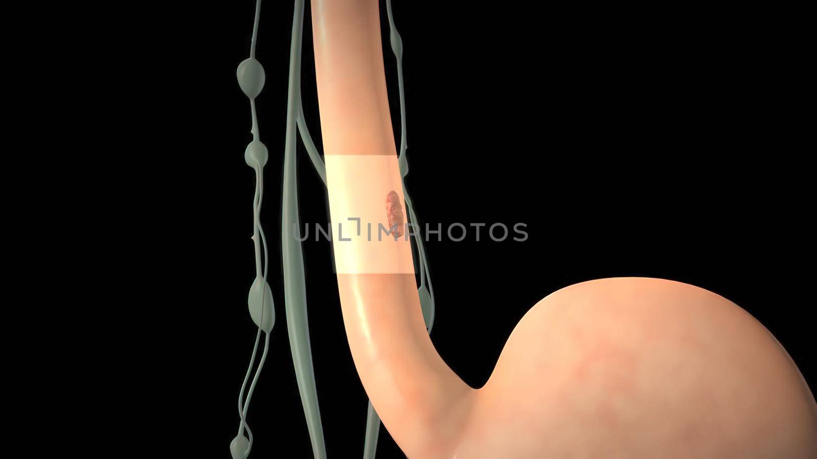 Squamous cell carcinoma - Esophagus tumor growing 3D illustration