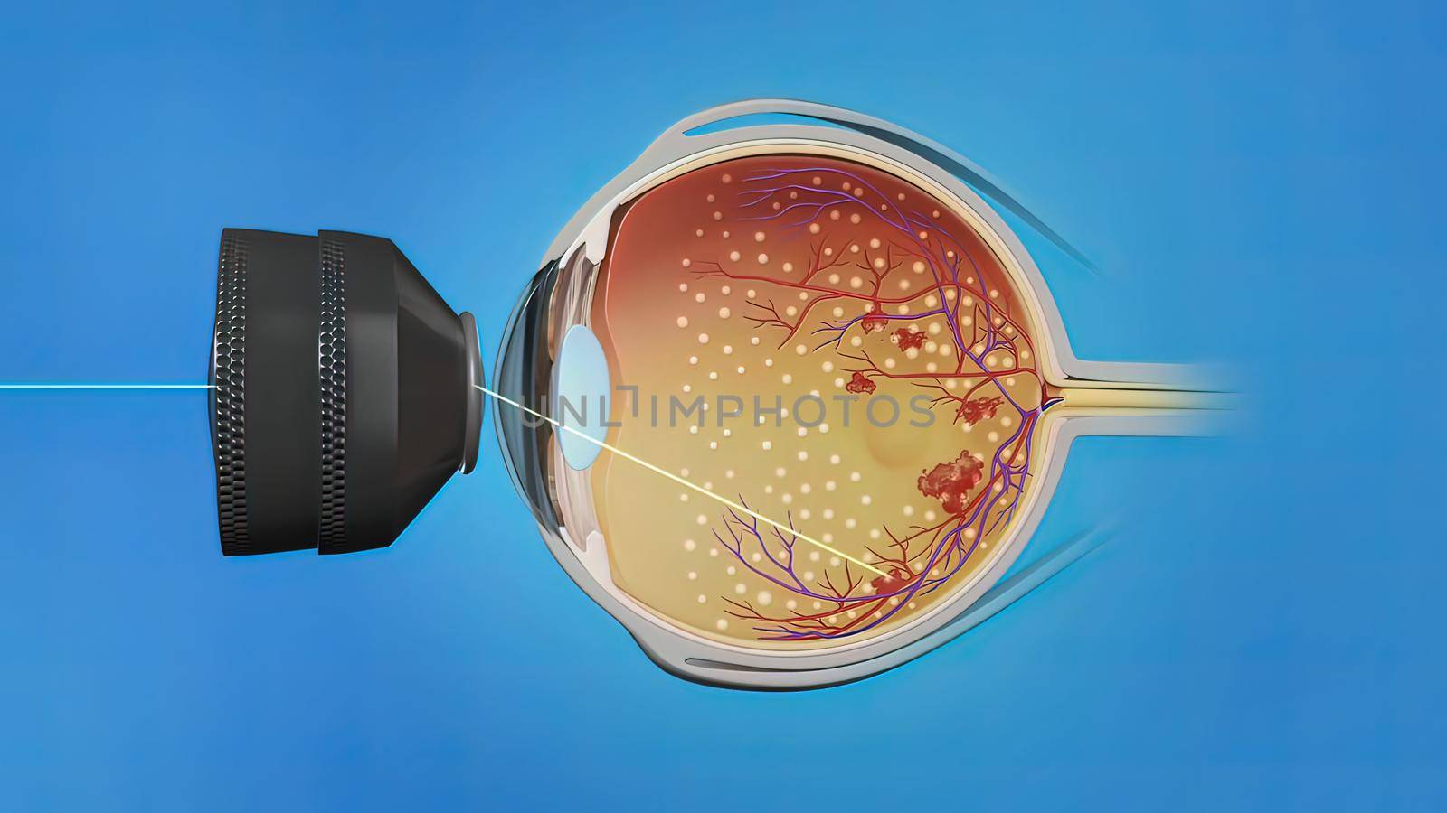 Laser surgery , eye laser treatment by creativepic