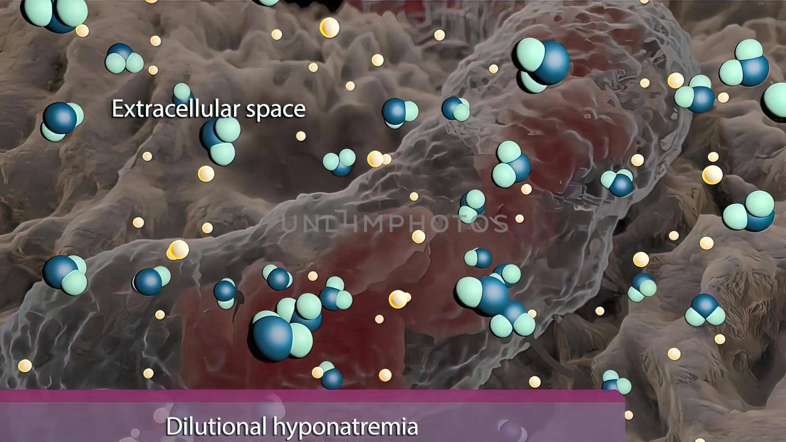 Dilutional hyponatremia, also known as water intoxication 3D illustration