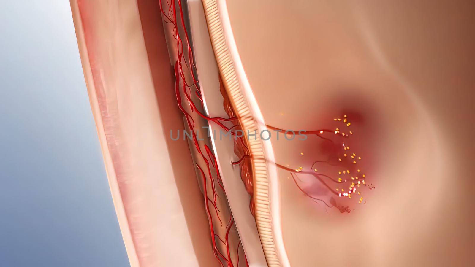 Glaucoma eye disease 3D illustration medical .