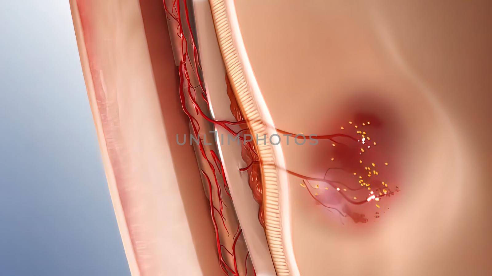 Glaucoma eye disease 3D illustration medical by creativepic