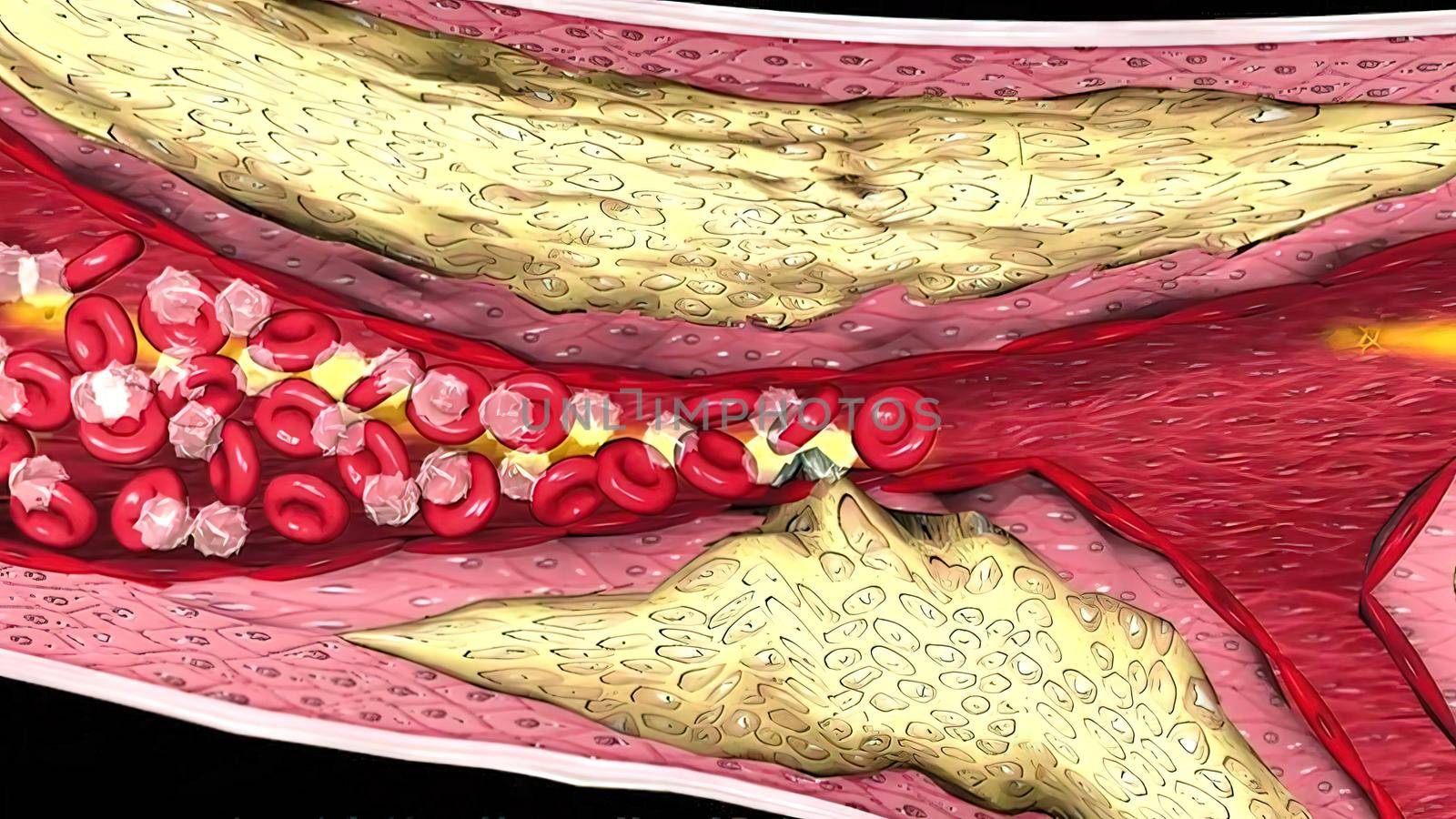 Coronary atherosclerosis, light micrograph showing cholesterol-containing plaque by creativepic