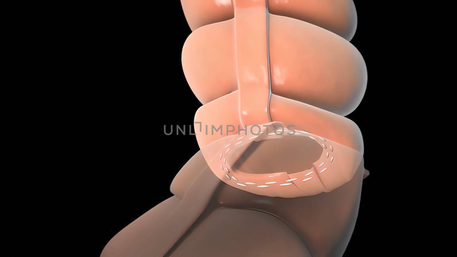 surgery to remove any part of the intestines, bowel resection 3D illustration
