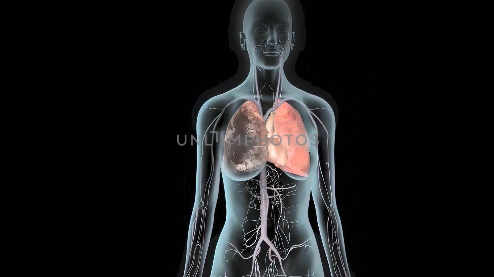 Pulmonary embolism occurs when a clump of material, most often a blood clot, gets wedged into an artery in your lungs. 3D Illustration