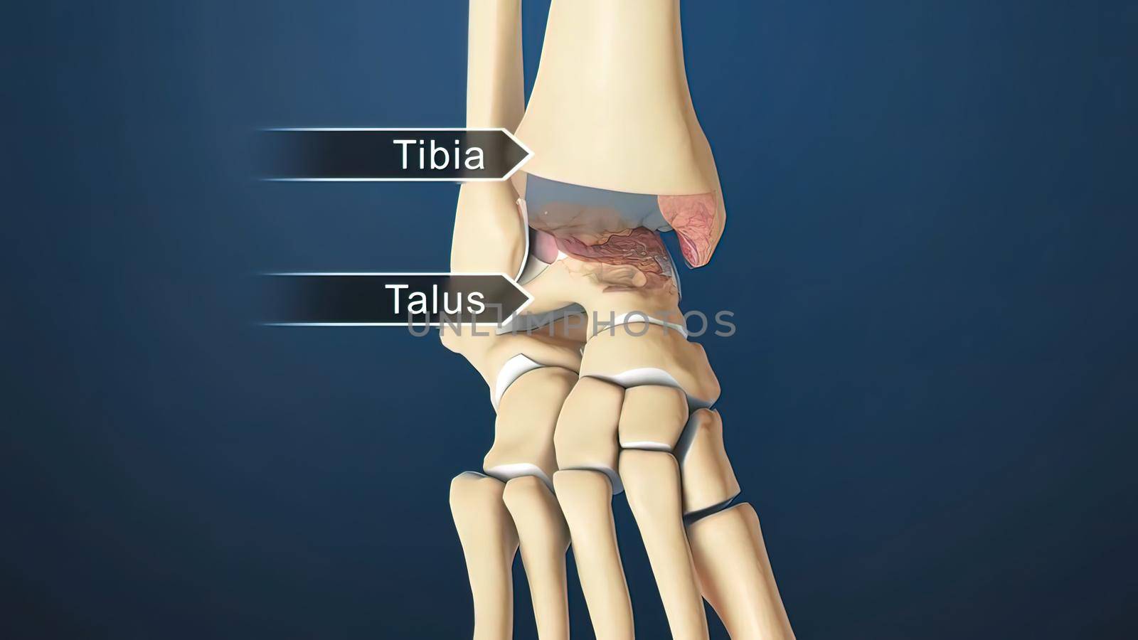 3D Render of Ankle Joint Anatomy and Osteoarthritis.The ankle is where the long tibia and fibula bones of the shin meet with the foot s talus bone.