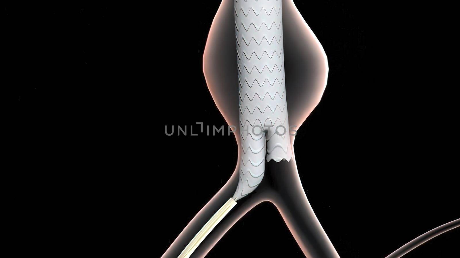 3D medical illustration of pulsatile Abdominal Aortic Aneurysm