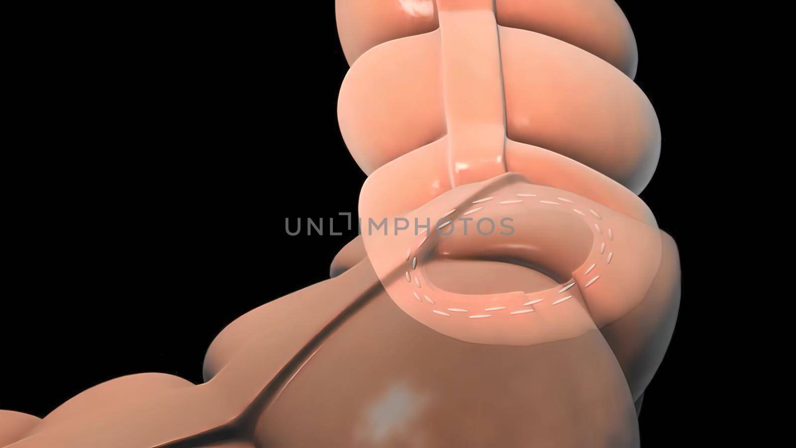 surgery to remove any part of the intestines, bowel resection by creativepic